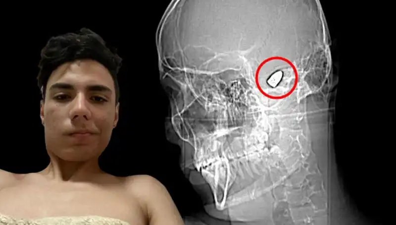Kafasının İçinde Patlamaya Hazır Bomba ile Yaşayanların Dramı